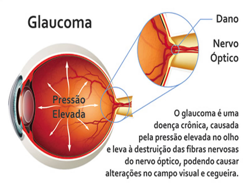 Mutirão de combate ao glaucoma acontece neste sábado em Paripe